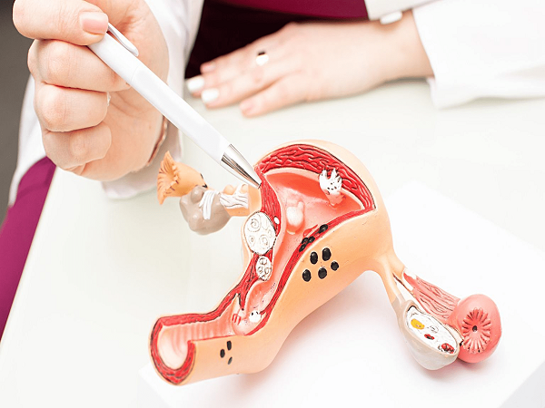 腺肌症自愈的十大方法汇总，除运动、泡脚你还得知道这些