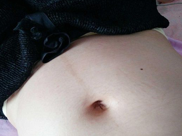 产后各种妊娠纹真实图片分享，腿上、肚皮凸起发红很常见