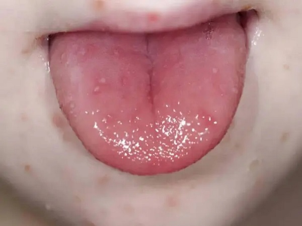 手足口疫苗千万不要打有原因，除这5种情况外该打还得打