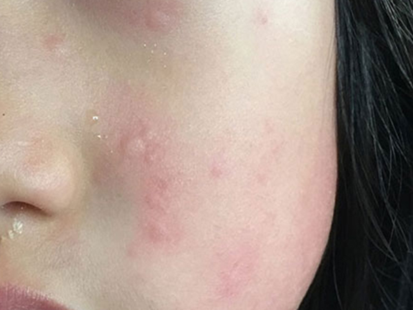 荨麻疹最怕的三个土方法分享，艾草、葱白记住一个就行