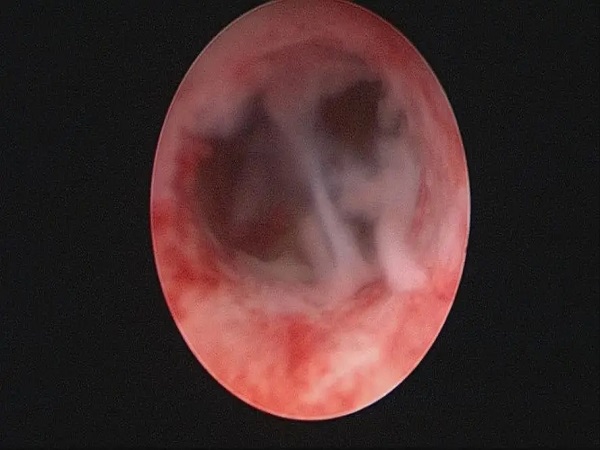 宫腔粘连每天盐袋热敷的作用分享，效果好不好因人而异