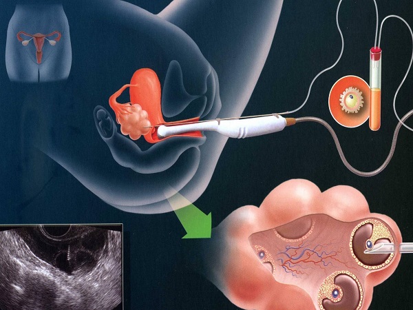 试管取卵有空卵泡的3大原因汇总，技术问题可避免要了解