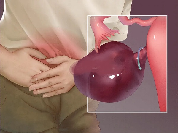 盘点卵巢囊肿最怕的三种水果：多吃火龙果对身体有好处