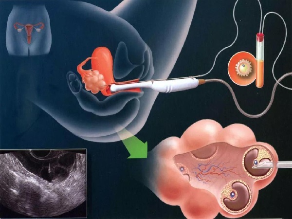 盘点卵泡穿刺和取卵手术的区别，看完操作流程就知哪个疼