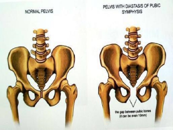 简单六个小动作可让骨盆变窄，假胯宽姐妹赶紧收藏练起来！