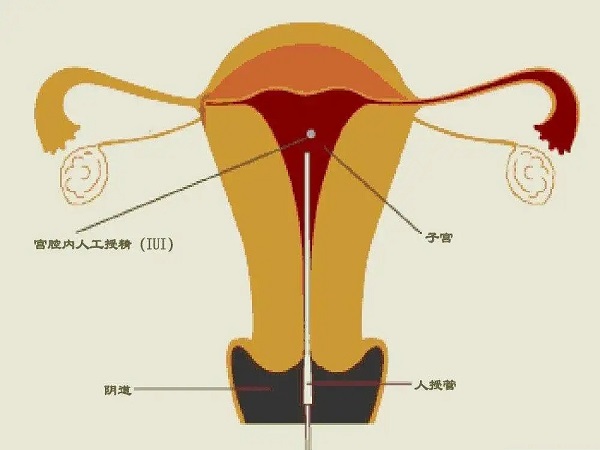 人工授精第七天成功的症状汇总，身体有这些感觉要留意