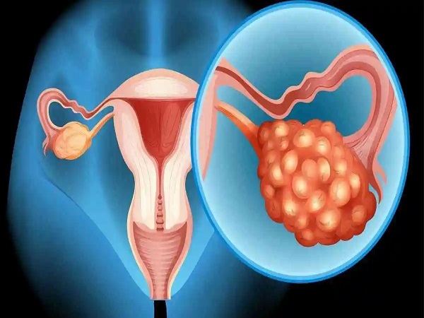 盘点多囊卵巢最怕三种水果，含糖量高的加重病情千万别吃
