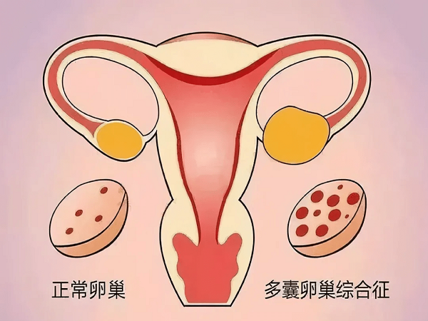 多囊促排怀双胞胎的经历分享，正确使用药物成功率真不低