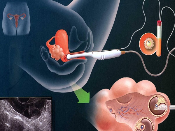 细数取卵后卵巢恢复正常的4大表现，别只知道月经来潮了