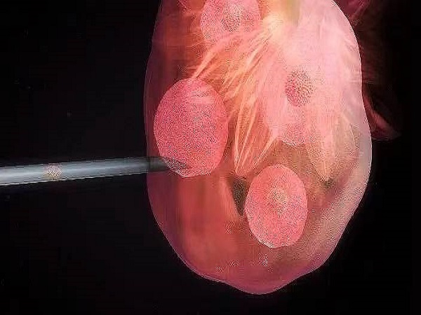 试管促排卵泡大小不均匀能补救，这三种方法效果好快试试