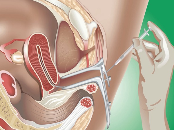 试管婴儿不是必须双腔取卵，遇到这三种情况才真有必要