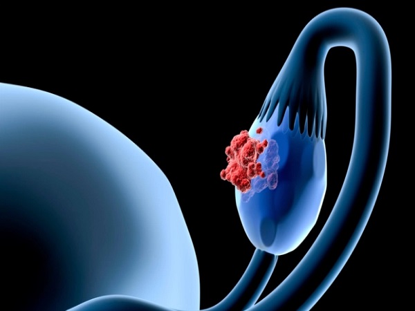 做试管婴儿怕子宫内膜异位真不假，影响成功率不是瞎说