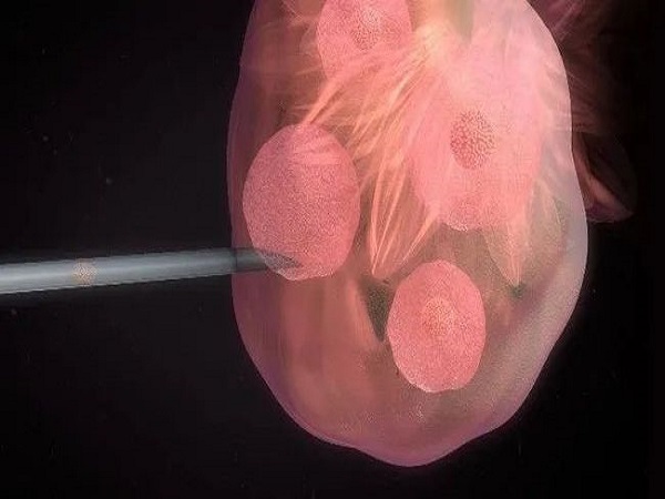 试管进周后就禁止同房有原因，对卵泡质量有影响要知晓