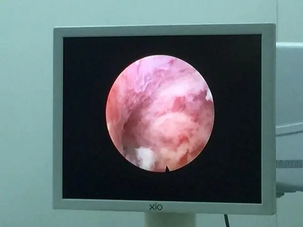 试管婴儿并非每个人都要做宫腔镜，这三大适用人群要认准