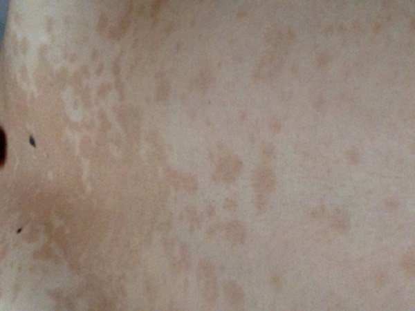 神经纤维瘤病三代试管成功案例分享，能阻断疾病遗传别错过