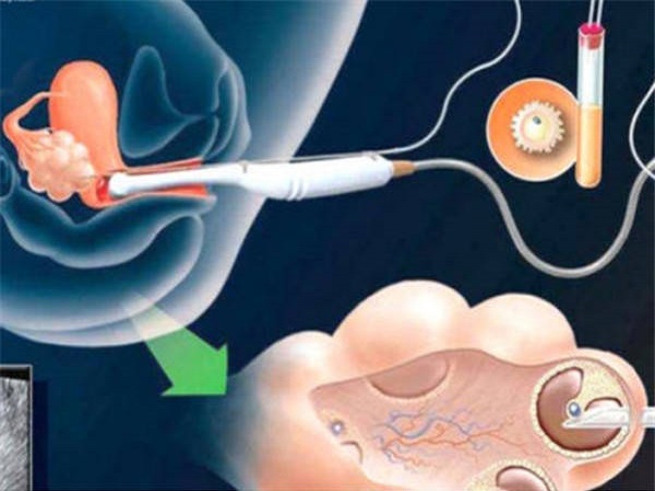 试管取完卵后的注意事项分享：多吃这些食物可防止腹水