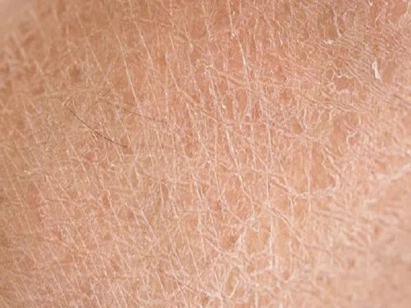 先天性鱼鳞病需要做三代试管，能阻断后代遗传可放心生育