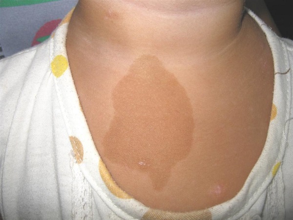 神经纤维瘤的遗传规律分享，会不会隔代遗传看完不存疑