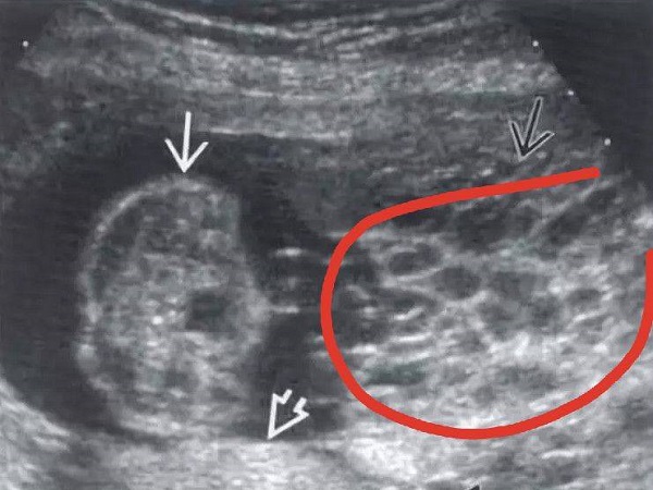 得过葡萄胎做试管婴儿有条件，满足这几种情况下可考虑