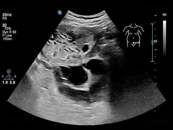 解读葡萄胎早期的8个征兆，出现阴道出血症状就要注意了