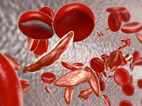 夫妻双方地贫备孕方法分享，这些注意事项是关键不可不知