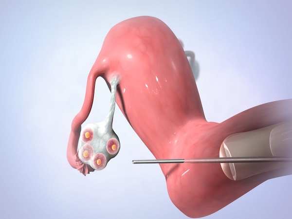 试管婴儿诊刮后取卵时间真急不得，多久可以取卵因人而异