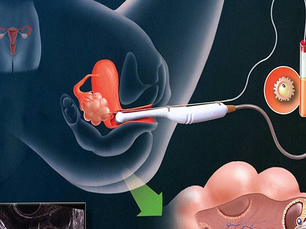 试管取一次卵可以移植几次看这里，配成的胚胎数量是关键