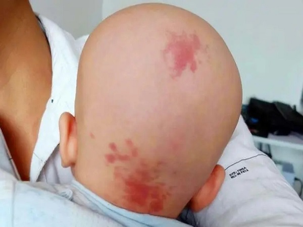 解读锁骨下有胎记的女人命运，好不好、代表什么看看就知道