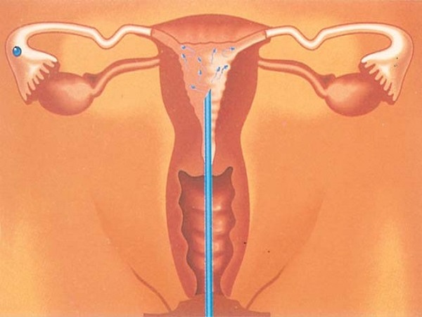 人工授精老公需要去医院千万别忘记，要去几次因人而异