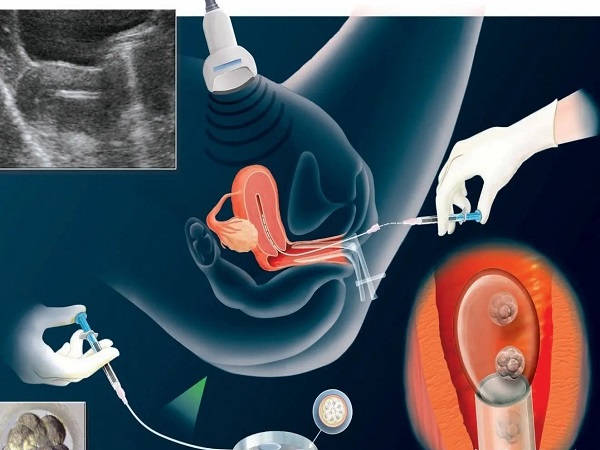 试管取卵全为空卵的概率没想象中高，做好预防工作很关键