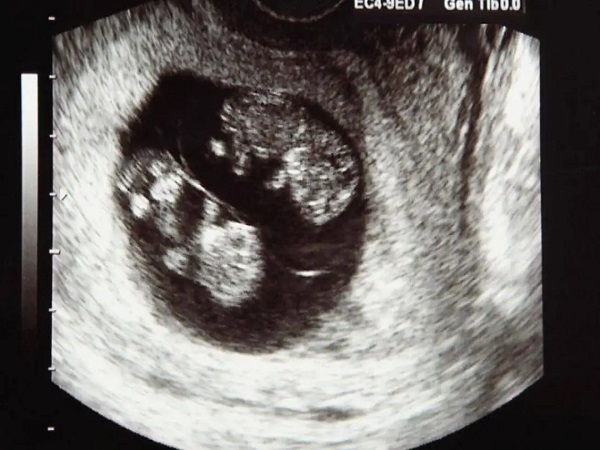 想生双胞胎的促排卵方法汇总，吃这些可提高几率别错过