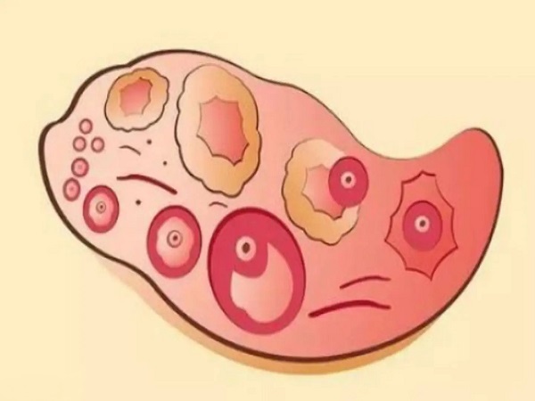 一文详解排卵后的卵泡，塌陷多长时间消失正常看这就知道