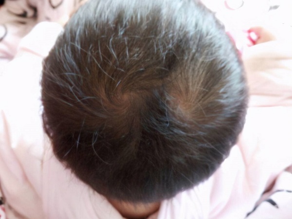 宝宝头顶漩涡处有个硬包别忽视，多和疾病有关真没吓唬你