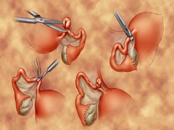 女人结扎了也可以做试管，做好这些注意事项怀孕真不难