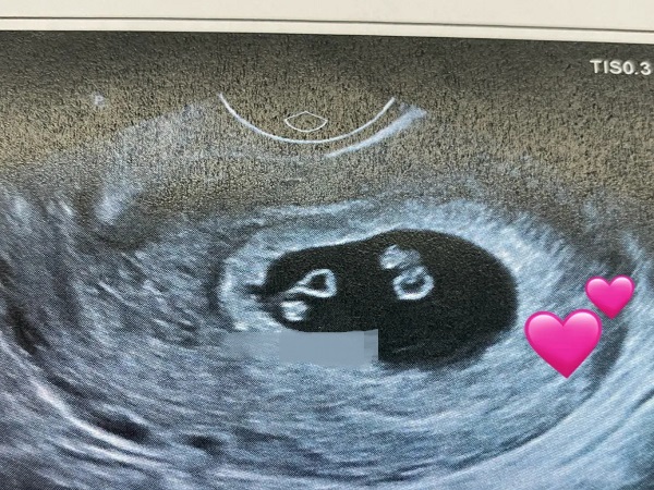 盘点一个孕囊双胞胎的早期前兆，早孕反应强烈就要恭喜了