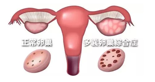 巧克力囊肿患者，可以做俄罗斯试管婴儿吗？