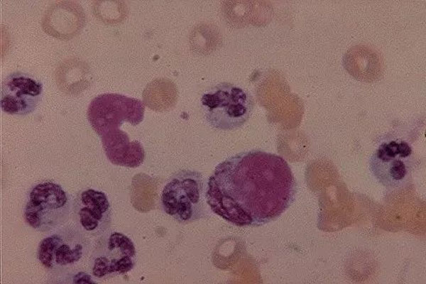 患有红斑狼疮还能去泰国做试管婴儿吗？