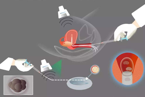 试管移植放入过程是怎样的