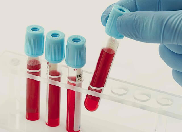 女性做试管前的生殖免疫全套检查项目都包括哪些？