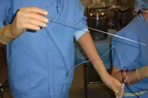 女人最多能取卵几次？超过上限很危险