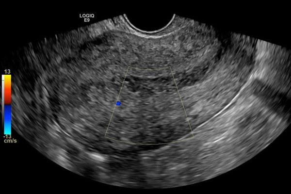 宫腔粘连通过手术治疗，多久可以怀孕？几率大吗？