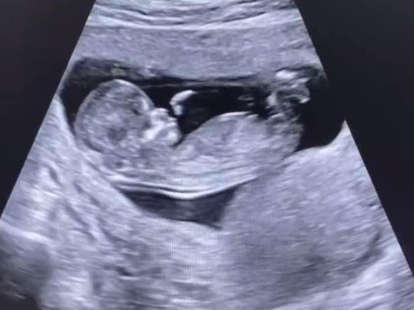 NT值3.5未见鼻骨，做羊穿的通过率高吗？