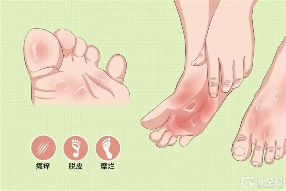 孕妇治脚气的5个最佳方法，早看早受益