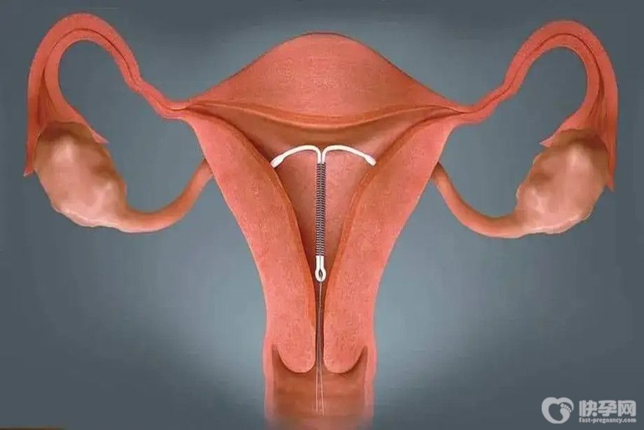 为什么医生不建议女性上环？其中的危害看完你就明白了