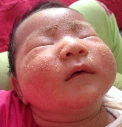 去除新生儿脸上湿疹小妙招（湿疹止痒妙招）