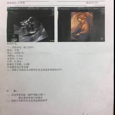 怀孕做的nt是什么检查（孕期NT查的是什么）