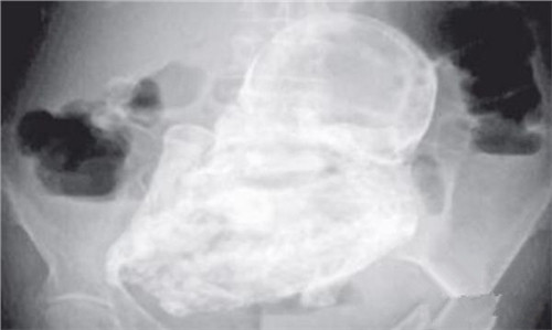 肚子里怀的是死胎有什么症状（死胎多久肚子会疼）