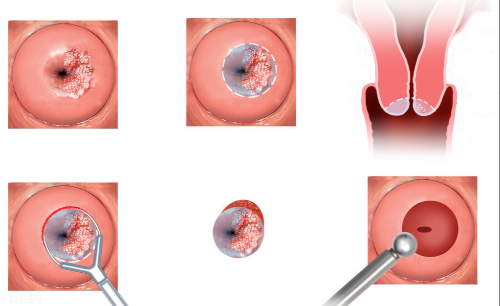 宫颈性不孕是怎么造成的(精子穿不过宫颈是什么原因）