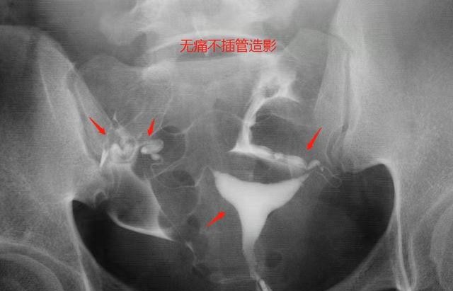 造影后多久可以怀孕