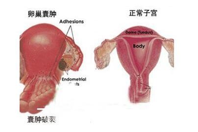 患有卵巢囊肿可以怀孕吗